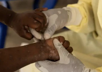 África alcanza los 622 muertos por la mpox mientras espera la llegada de vacunas