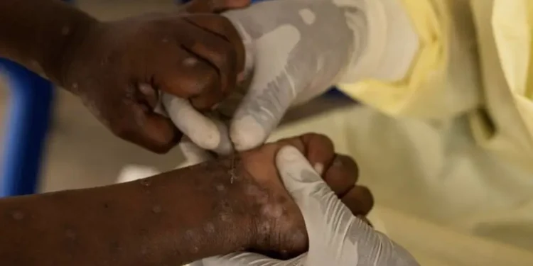 África alcanza los 622 muertos por la mpox mientras espera la llegada de vacunas