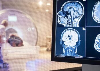 Revelan que un caso grave de covid-19 envejece el cerebro 20 años