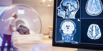 Revelan que un caso grave de covid-19 envejece el cerebro 20 años