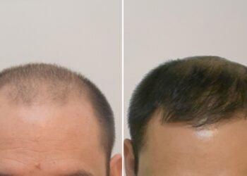 El trasplante de pelo: un «cambio de cielo a tierra» para la autoestima de muchos hombres