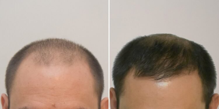 El trasplante de pelo: un «cambio de cielo a tierra» para la autoestima de muchos hombres