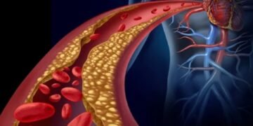 “El colesterol alto no duele, pero mata”