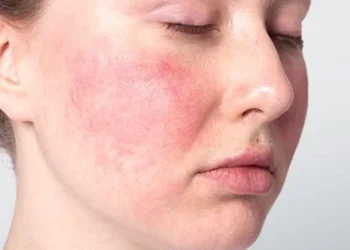 Dermatitis atópica figura entre las principales afecciones dermatológicas en RD