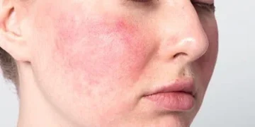 Dermatitis atópica figura entre las principales afecciones dermatológicas en RD
