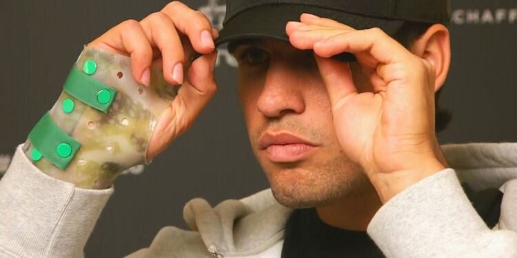 Se revela la lesión que tiene Alcaraz en la muñeca