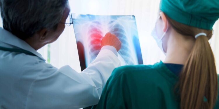 Cáncer pulmonar: la importancia del diagnóstico temprano